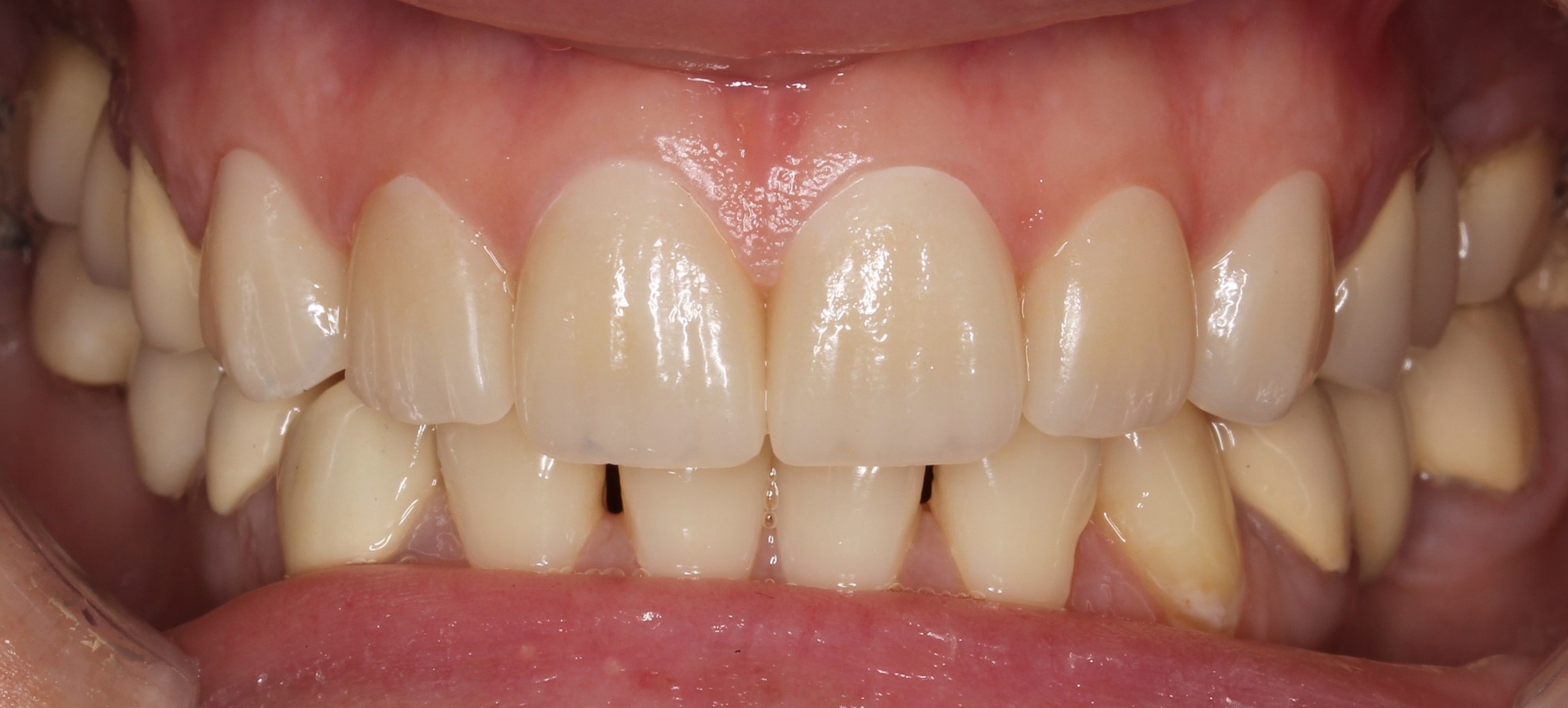  dental veneers Phuket, best dentist in Phuket, dentist Phuket, veneers Phuket